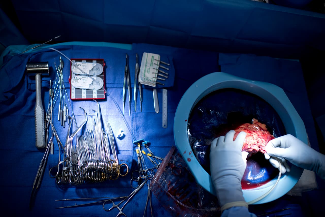 "Como regla general, usted no pondría un riñón de alguien de 80 años en una persona de 22", explica uno de los expertos. Pero puede ser apropiado trasplantar ese riñón en una de las más de 22,000 personas mayores de 65 años que están en lista de espera.