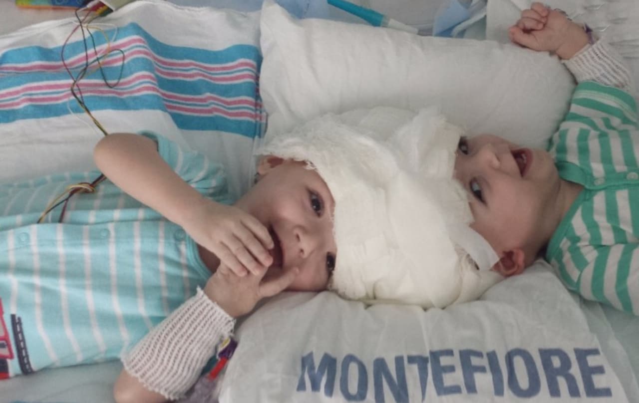 Anias y Jadon McDonald nacieron unidos por la cabeza, lo que ocurre en sólo 1 en cada 2.5 millones de nacimientos.