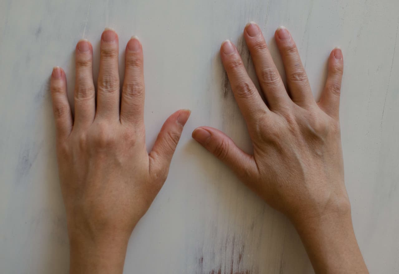 "No es una palabra conocida como cáncer, úlcera, pulmonía. Es artritis".