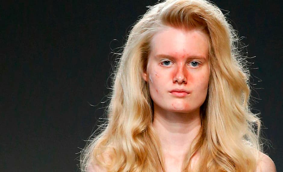 <h3>Menos productos antiacné y más sueño </h3>Solemos achacarle el estrés a las múltiples presiones que nos generan las actividades que desarrollamos durante el día. Sin embargo, la falta de sueño también puede provocarlo. Aquí es donde aparece la hormona cortisol, que el cuerpo libera como respuesta a esta condición, y que conlleva un proceso inflamatorio que estimula las glándulas sebáceas. Esta situación generalmente se manifiesta con un incremento del 
<a href="http://www.huffingtonpost.com/2015/12/20/sleep-loss-wrecks-face-body_n_8513960.html">acné</a>. 
<br>