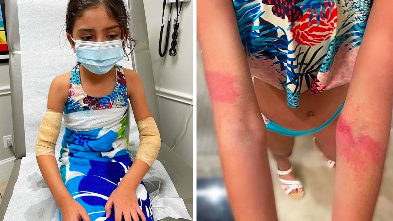 "Jamás tenemos que olvidar el peligro del mar": niña sufre ataque de medusas en playa de Texas