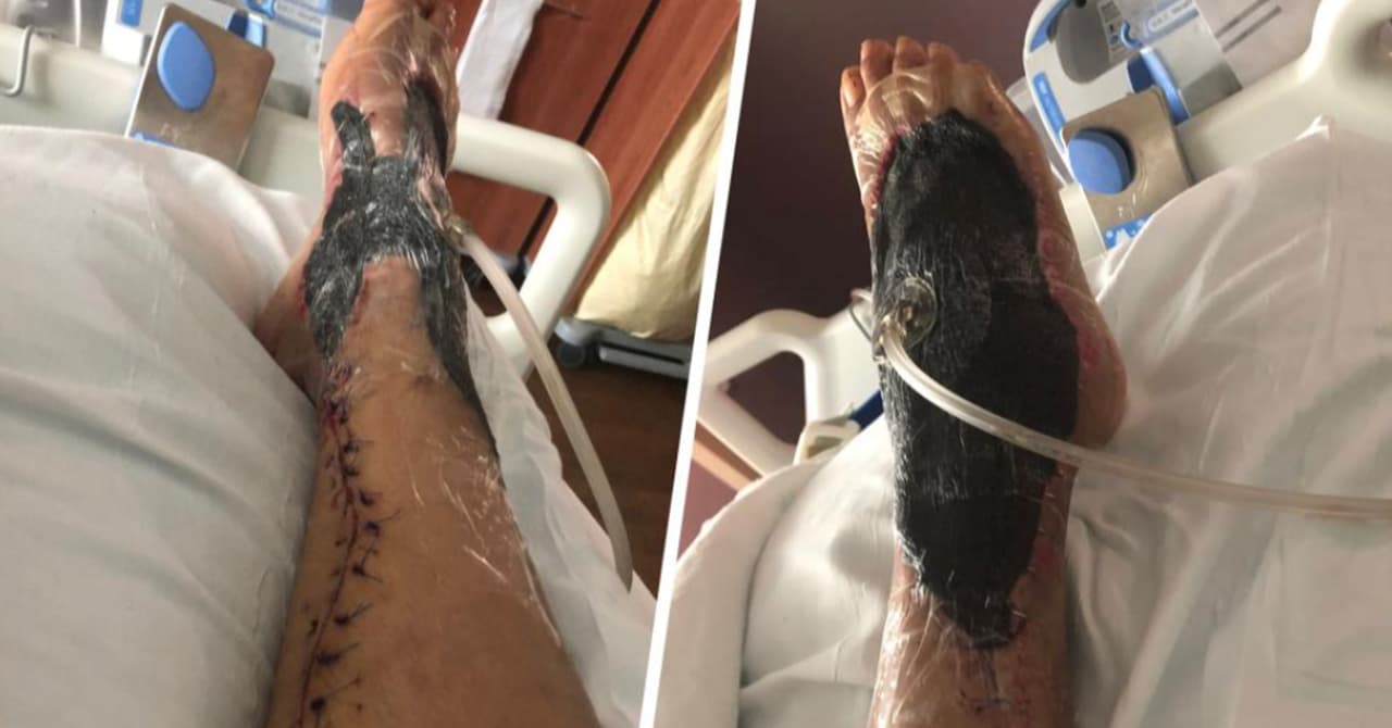 <b>El <i>Vibrio</i> puede causar una infección mortal </b>conocida como fasciitis necrotizante, popularmente llamada "
<a href="https://www.univision.com/local/tampa-wvea/local/tampa-wvea/local/tampa-wvea/cdc-advertencia-bacteria-come-carne-florida-huracan-idalia">bacteria come carne</a>" , que destruye el tejido a gran velocidad si no se trata a tiempo.