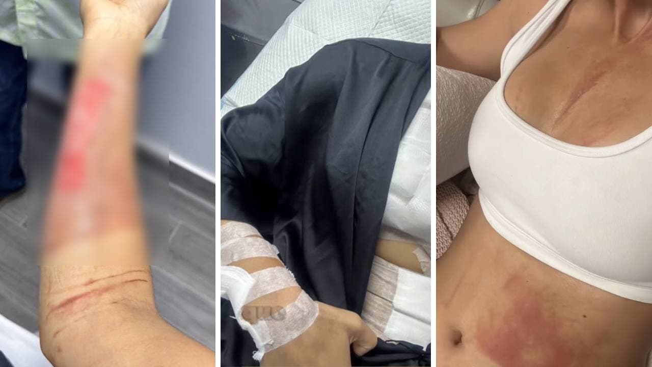 Debbie Aflalo sufrió un accidente doméstico.