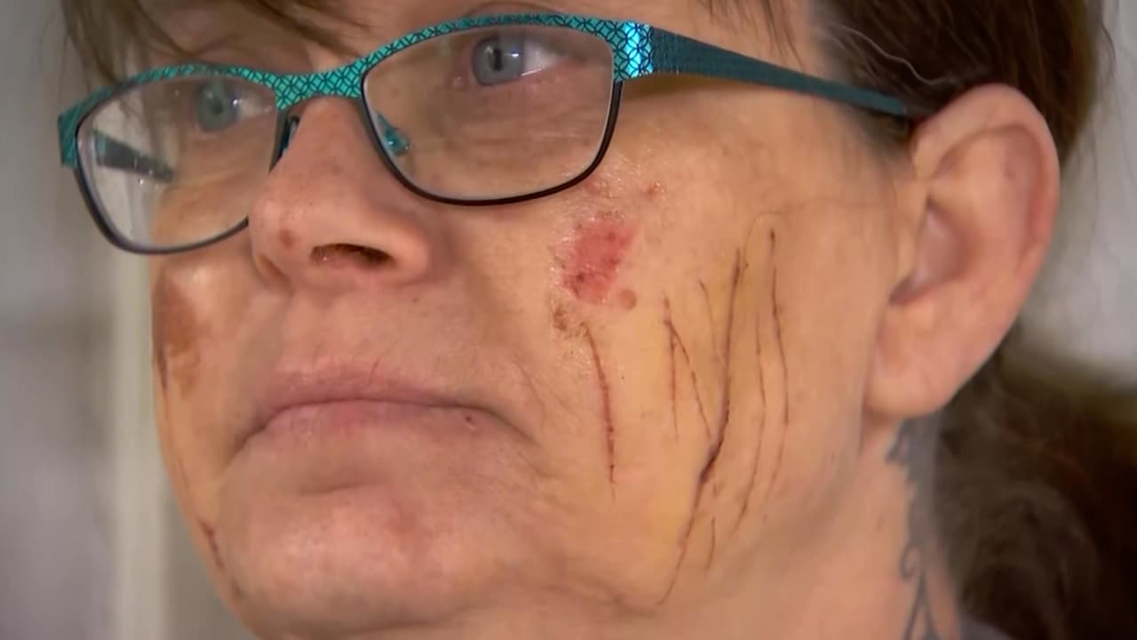 Mujer de Pensilvania agradece estar viva tras un ataque de coyote