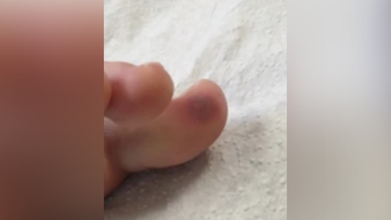 La otra manifestación es un problema de coagulación donde se hacen pequeñas trombosis.