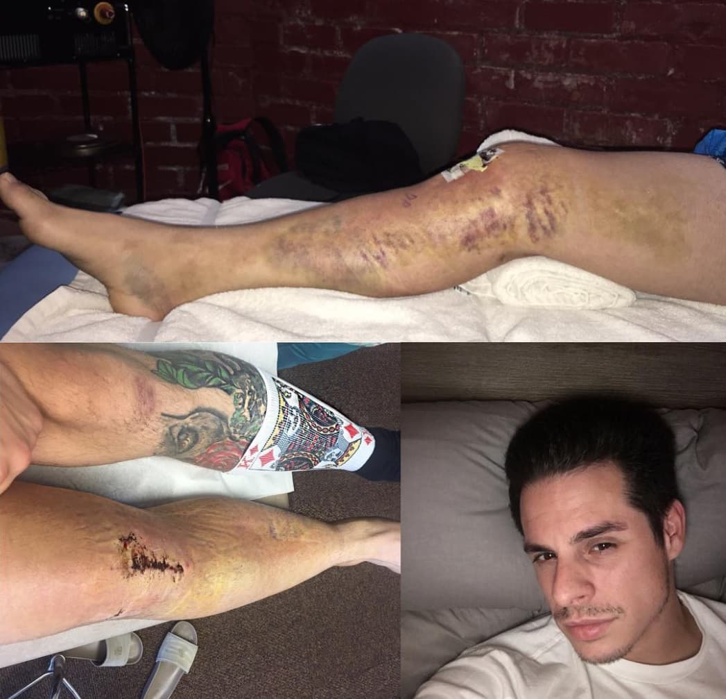 También lo han operado de la rodilla a consecuencia de otra caída de la motocicleta, esto sucedió el año pasado.