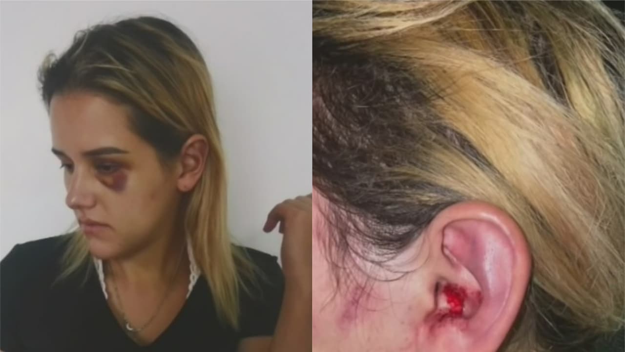 Mujer víctima de una golpiza en el Metromover demanda al condado Miami-Dade