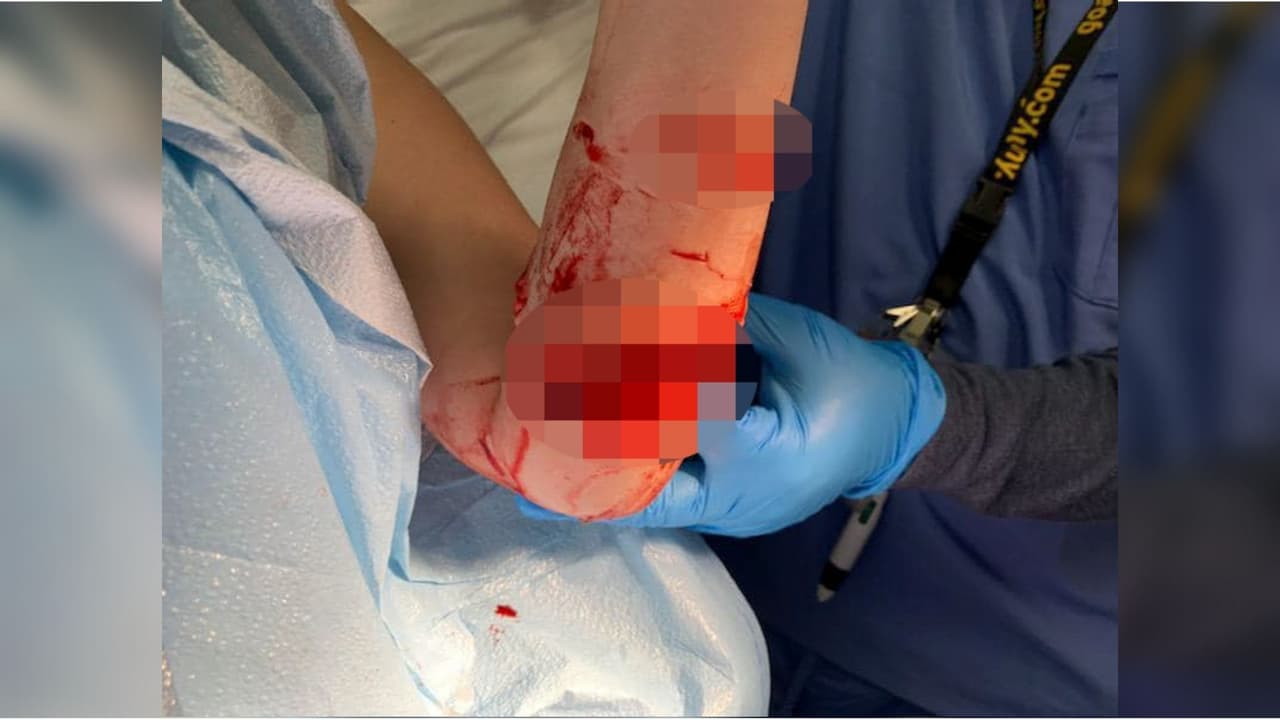 La mordida atroz que sufrió una joven de Cabo Rojo mientras disfrutaba de la playa