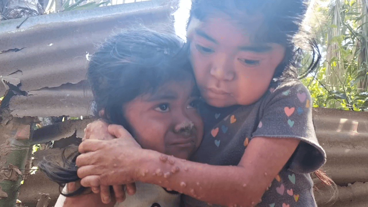Ayuda de Impacto: Estas hermanitas necesitan dinero para comprar medicina y así curar la rara enfermedad que sufren en la piel