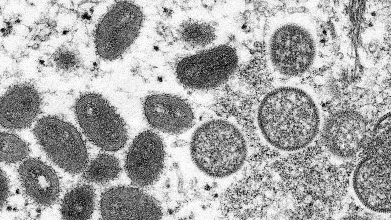 Condado de DuPage detecta primer caso sospechoso de viruela del mono