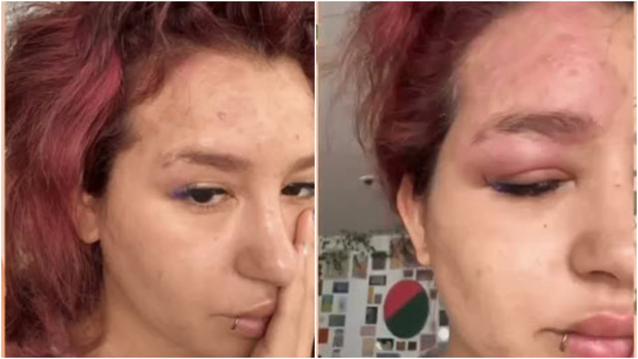 La hija de Niurka sufrió una fuerte inflamación en el rostro.