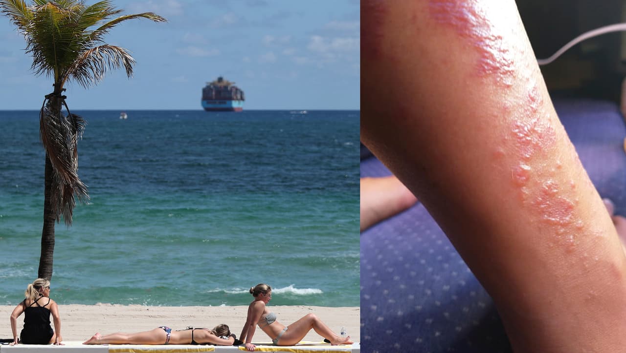 Mujer se infecta con la bacteria “come carne” en una playa de Florida 