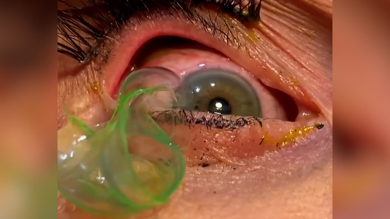 Una doctora remueve 23 lentes de contacto del ojo de una paciente en California