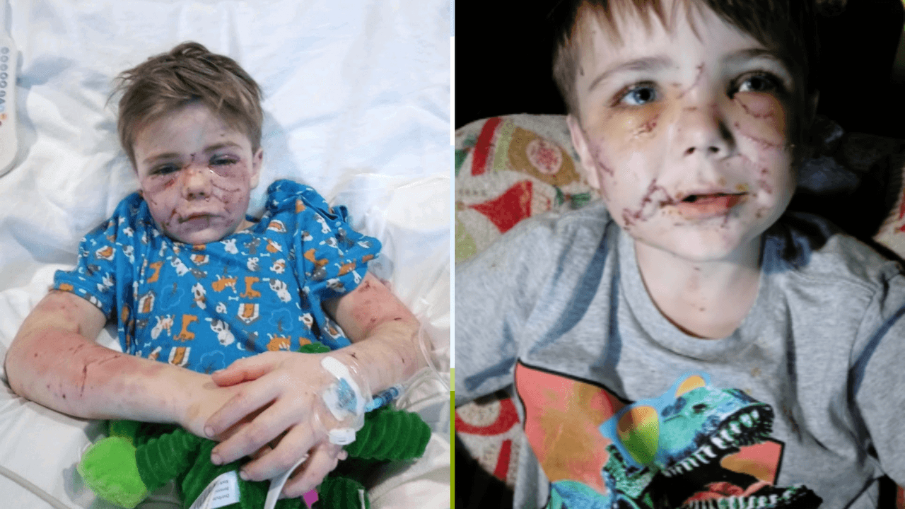 Un perro ataca un niño en un vecindario de Texas y lo deja desfigurado