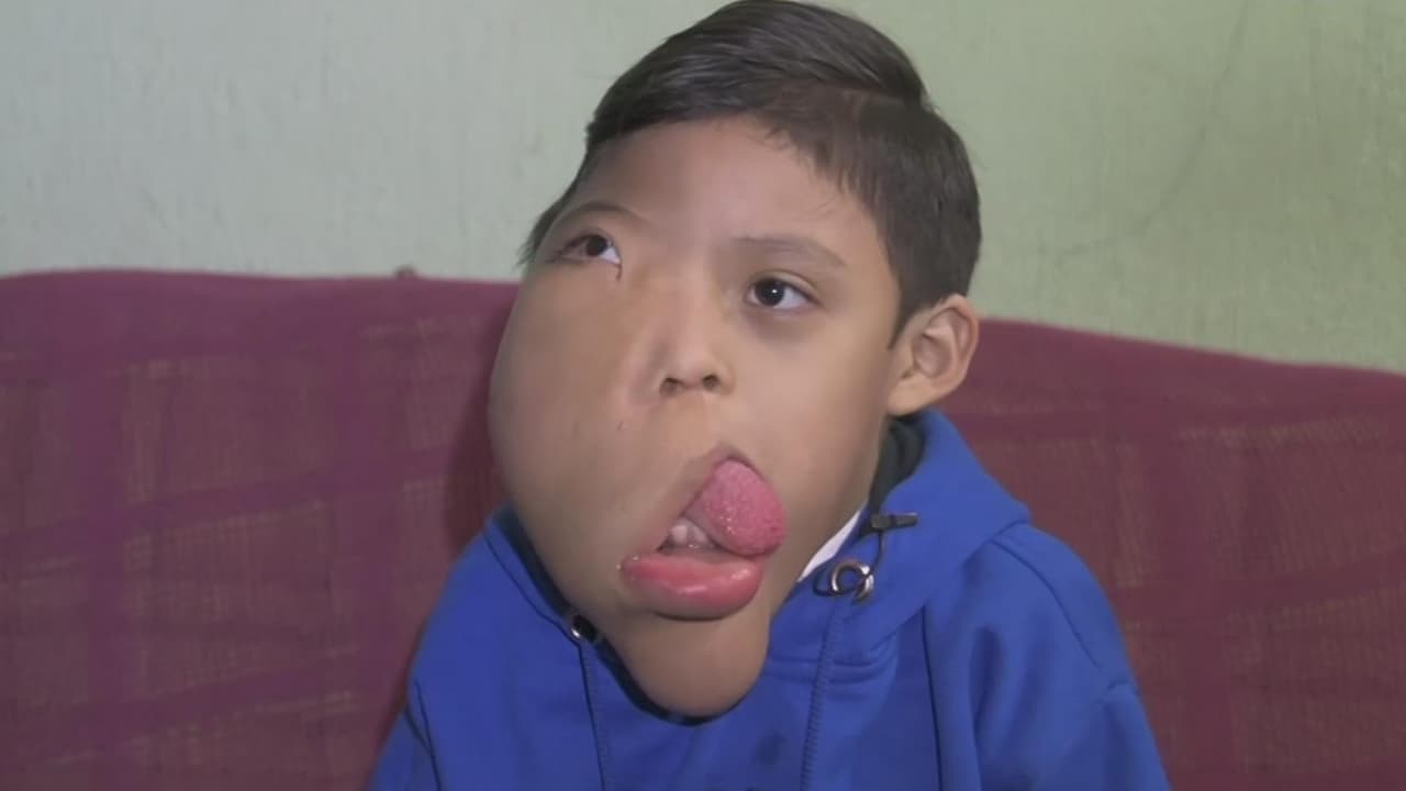 Ayuda de Impacto: Este niño nació con una deformación en el rostro que se ha agravado
