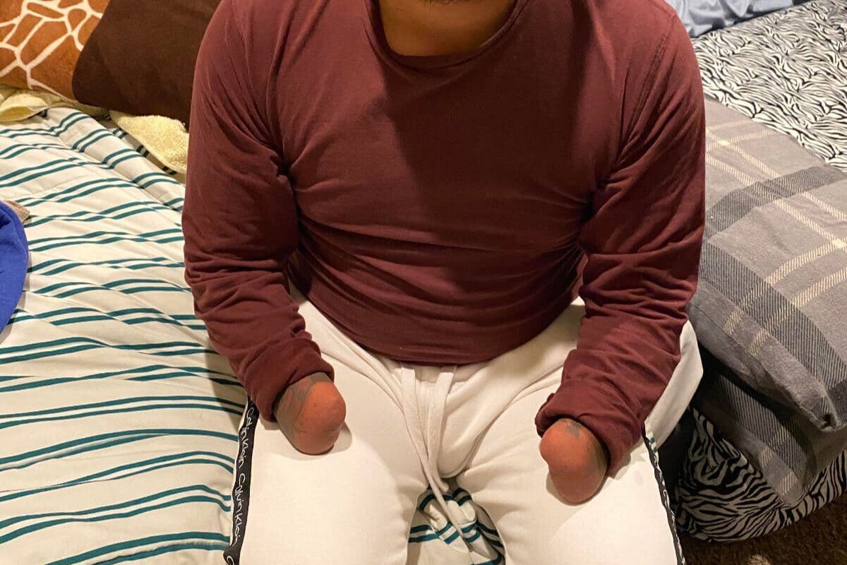 Secuestradores le mutilaron las manos porque no pagaron el rescate: ahora rehace su vida en EEUU