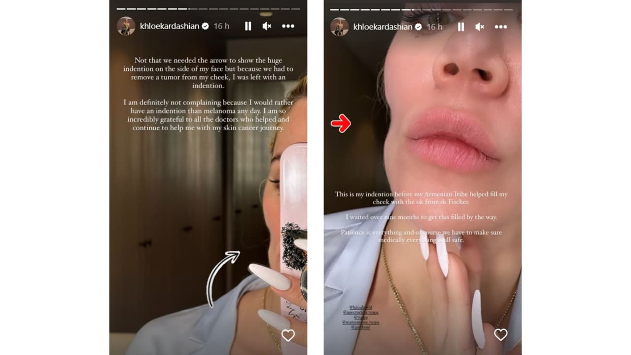 Khloé Kardashian tiene una "hendidura" en su rostro.