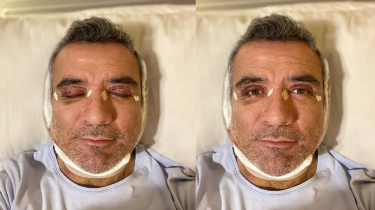 Héctor Sandarti tras someterse a cirugía plástica.