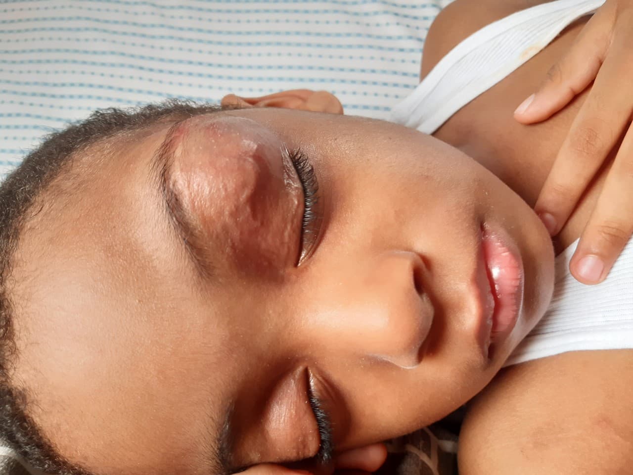 Ian Cabrera fue diagnosticado con una
<b><a href="https://espanol.ninds.nih.gov/trastornos/malformaciones_arteriovenosas.htm">malformación arteriovenosa</a></b> en el área del ojo derecho, una condición que no lograron diagnosticar, ni podían tratar los médicos en República Dominicana. De no ser operado, podía sufrir peligrosas hemorragias e incluso perder la visión.