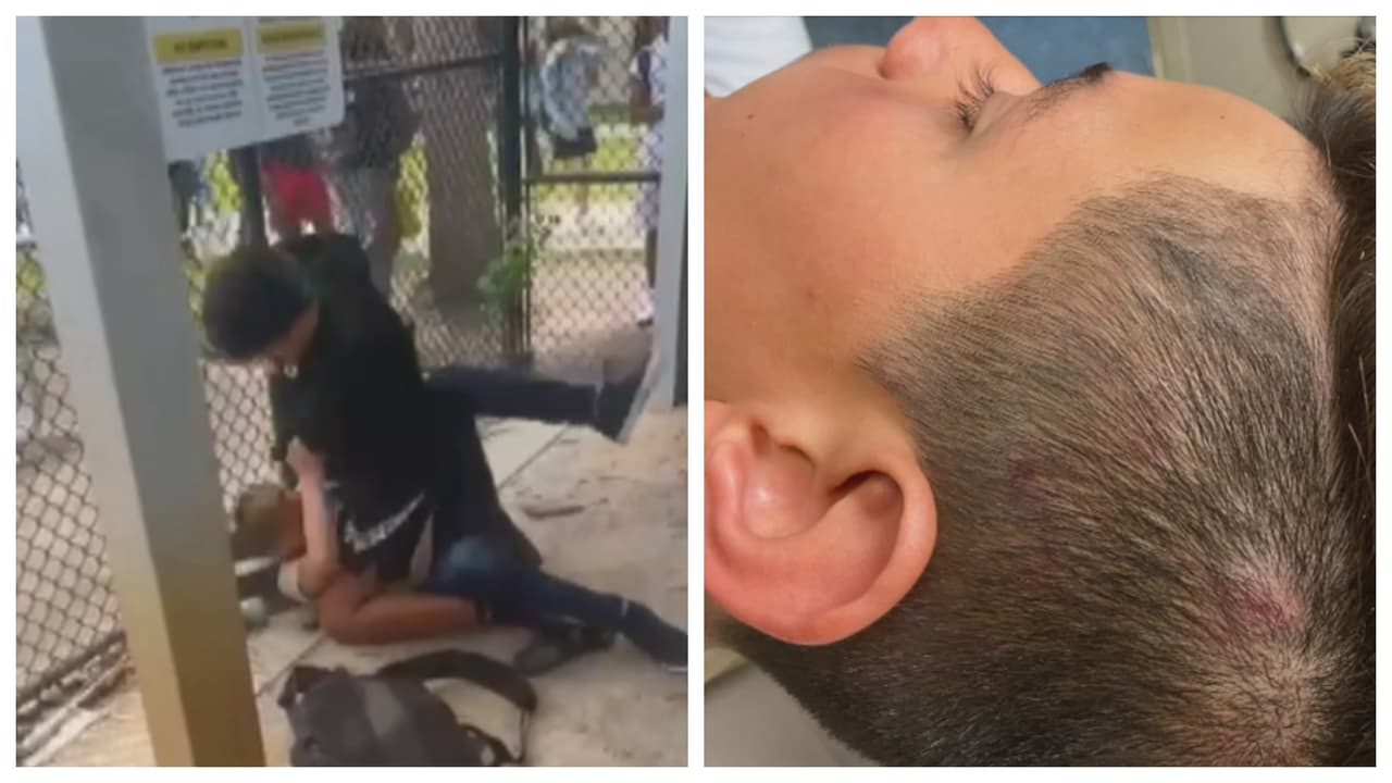 Niño de 13 años termina en el hospital tras recibir una brutal golpiza en una escuela de Broward