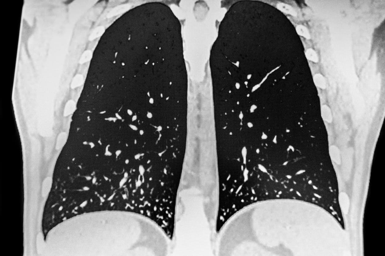 Hongos que causan infecciones pulmonares graves ya se encuentran por todo el país 