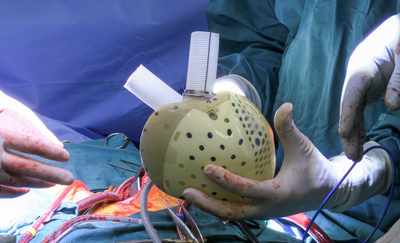 CARMAT ha sido estudiado en Europa, donde fue aprobado para su uso.