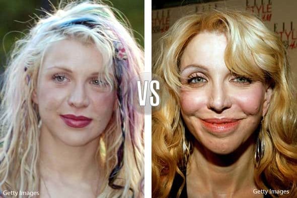 Courtney Love, la viuda de Kurt Cobain, no sólo abusó de las drogas, sino del bisturí.