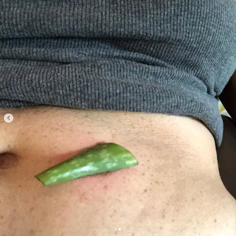 También mostró que el remedio casero que eligió para calmar su dolor fue 
<b>untarse aloe vera</b>.