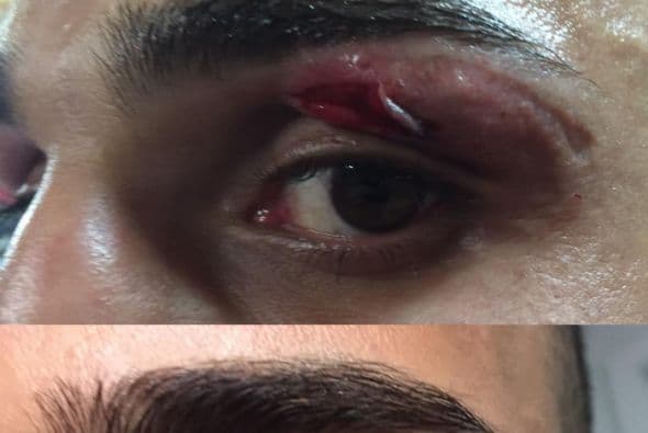 Paul Malignaggi pospone pelea por corte en la ceja