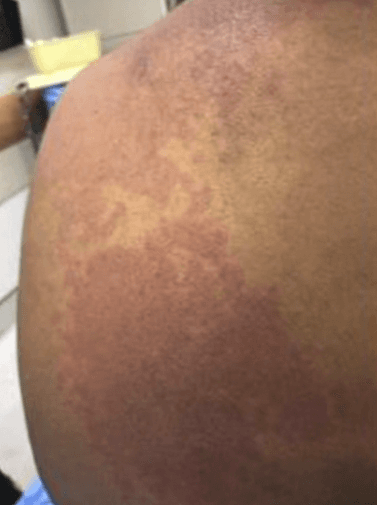 De los 2060 casos reportados por los CDC en Estados Unidos, en este hospital han tenido a más de 50 niños víctimas de esta enfermedad.