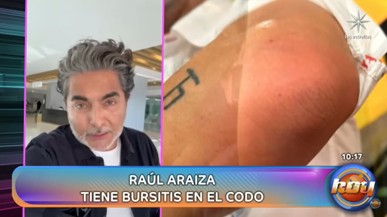 El diagnóstico de Raúl Araiza es "bursitis" en el codo.