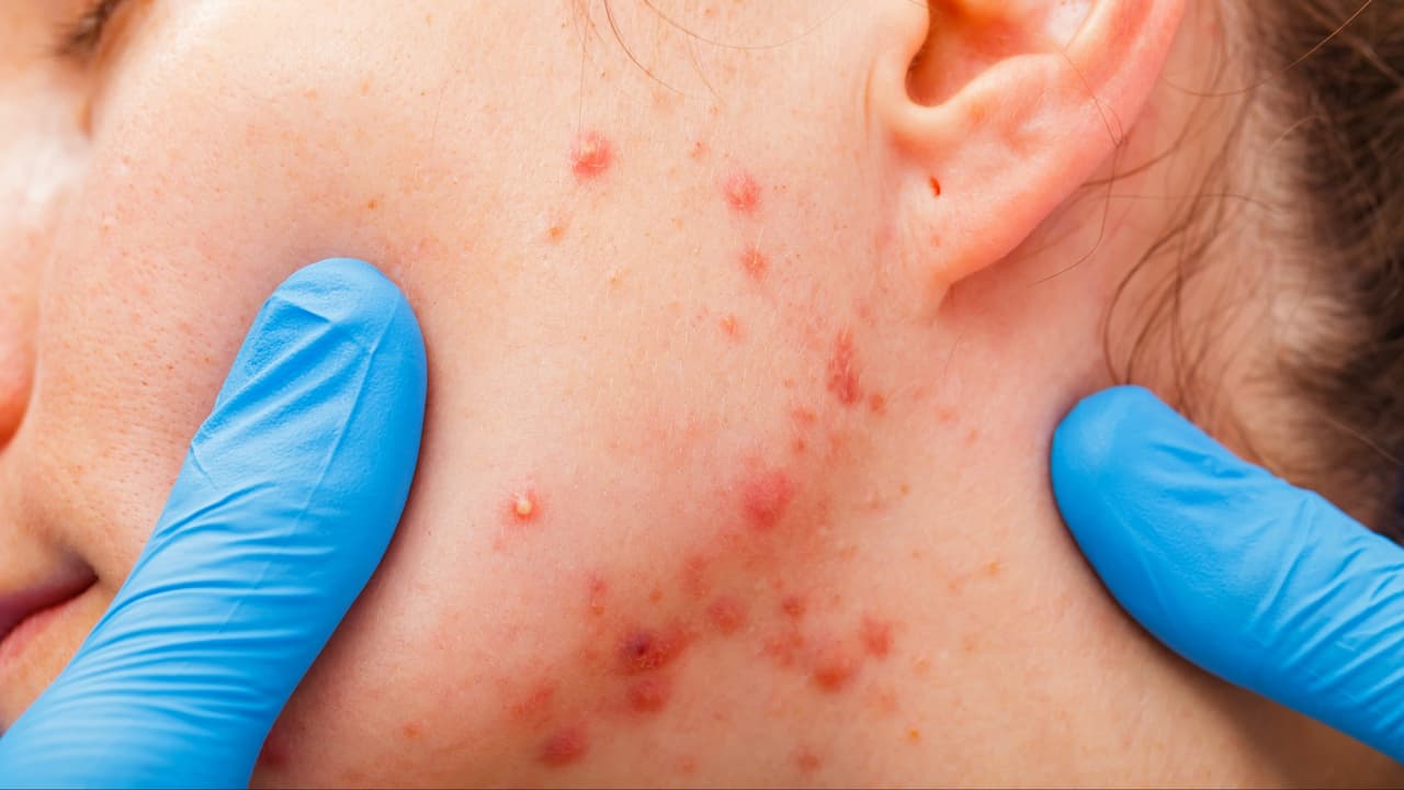 Un estornudo puede contagiar hasta 10 personas no vacunadas: por qué no debes subestimar el sarampión