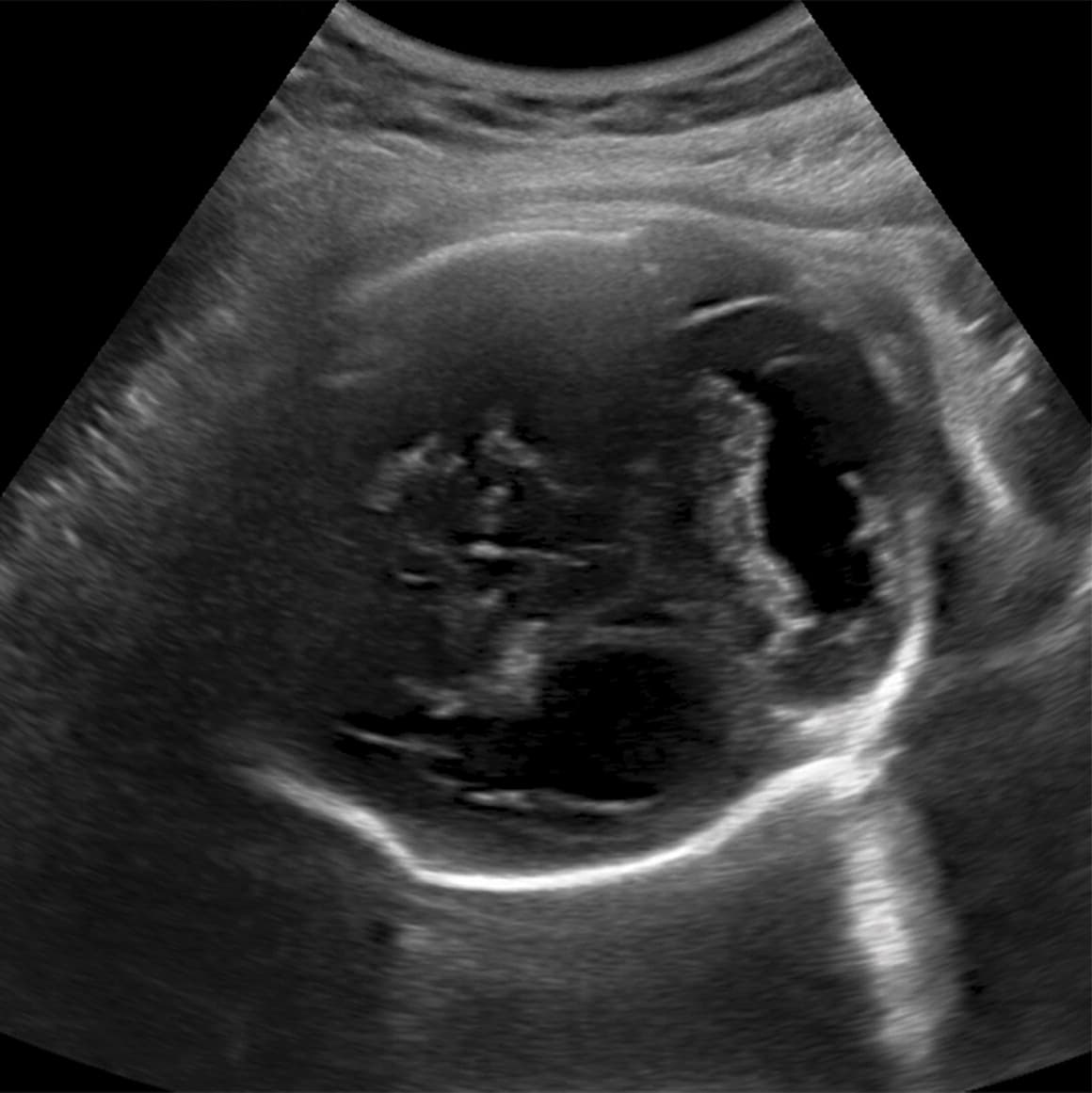 A las 12 semanas de embarazo, esta madre de 18 años tuvo una erupción en la piel. Su infección de zika fue confirmada en el Instituto de Pesquisa de Campina Grande, en Brasil.