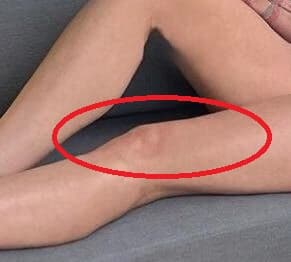 Ciertamente, al hacer un acercamiento hacia la foto se aprecia la marca que le dejó esa cirugía, parte del tratamiento que le salvó la vida.
<br>