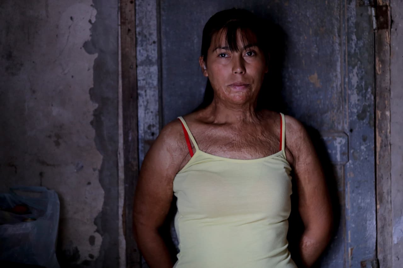 Maira Maidana temía que llegara el momento en que su pareja intentara matarla. El día en que la prendió en fuego, estaba ayudando a su madre a decorar un salón de baile para celebrar el 17 cumpleaños de su hermano menor. Estuvo en el hospital durante cuatro meses, mientras su madre cuidaba de sus hijos. Cincuenta y nueve cirugías más tarde, Maidana finalmente ha encontrado el valor de decir la verdad sobre lo que le sucedió la noche en que su marido la atacó. Asegura que debe ese valor al activismo de decenas de miles de personas en toda la Argentina para combatir la violencia contra las mujeres, ‘Ni Una Menos’.