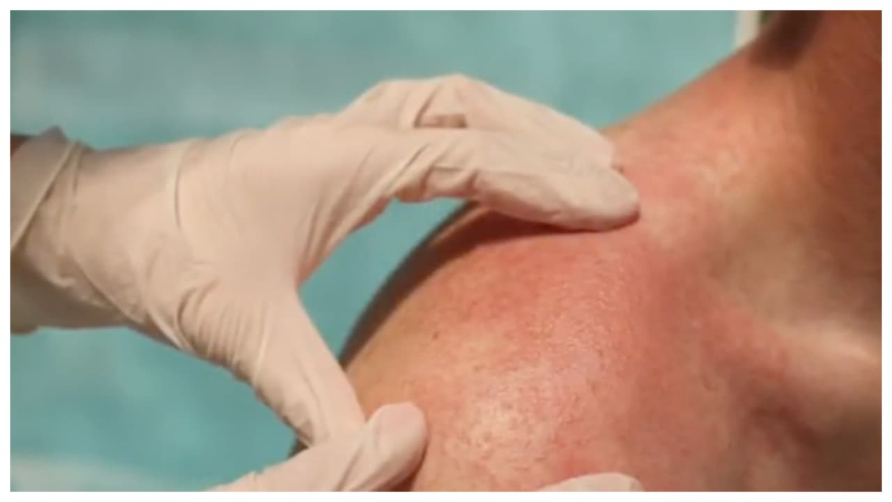 Vacuna contra el asma ayudaría a combatir alergias alimenticias