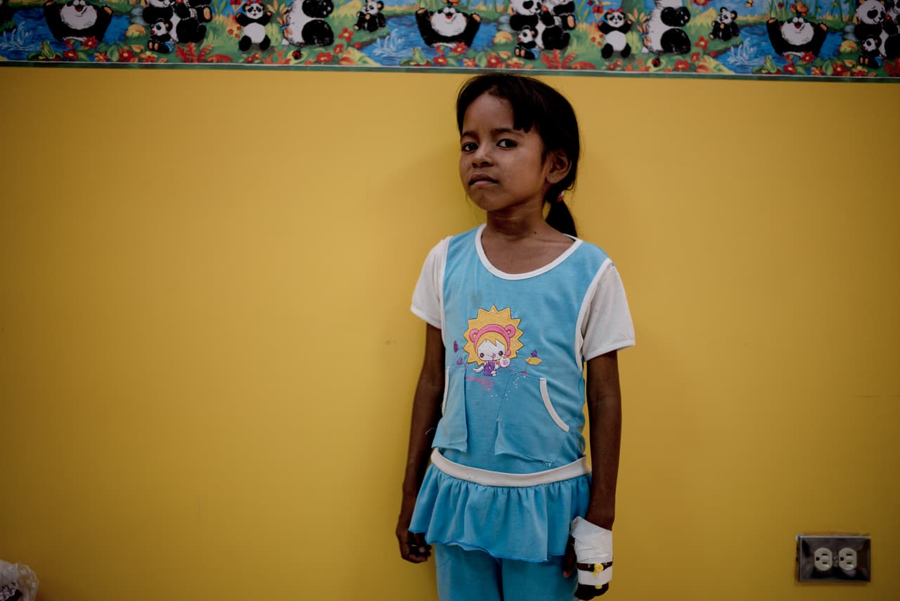 Muchos pequeños están hospitalizados con desnutrición severa, como esta niña que espera en una de las salas del hospital.