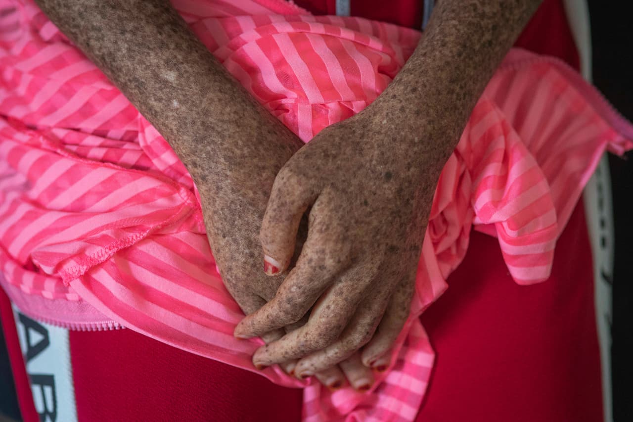 Debido a que el trastorno se hereda, la XP es más común en poblaciones donde el matrimonio entre parientes es alto, dijo Kraemer. Los niños afectados heredan dos copias de un gen mutado, una de cada padre. Un estudio del gobierno marroquí de 2016 estima que aproximadamente el 15% de los matrimonios son entre miembros de la familia.