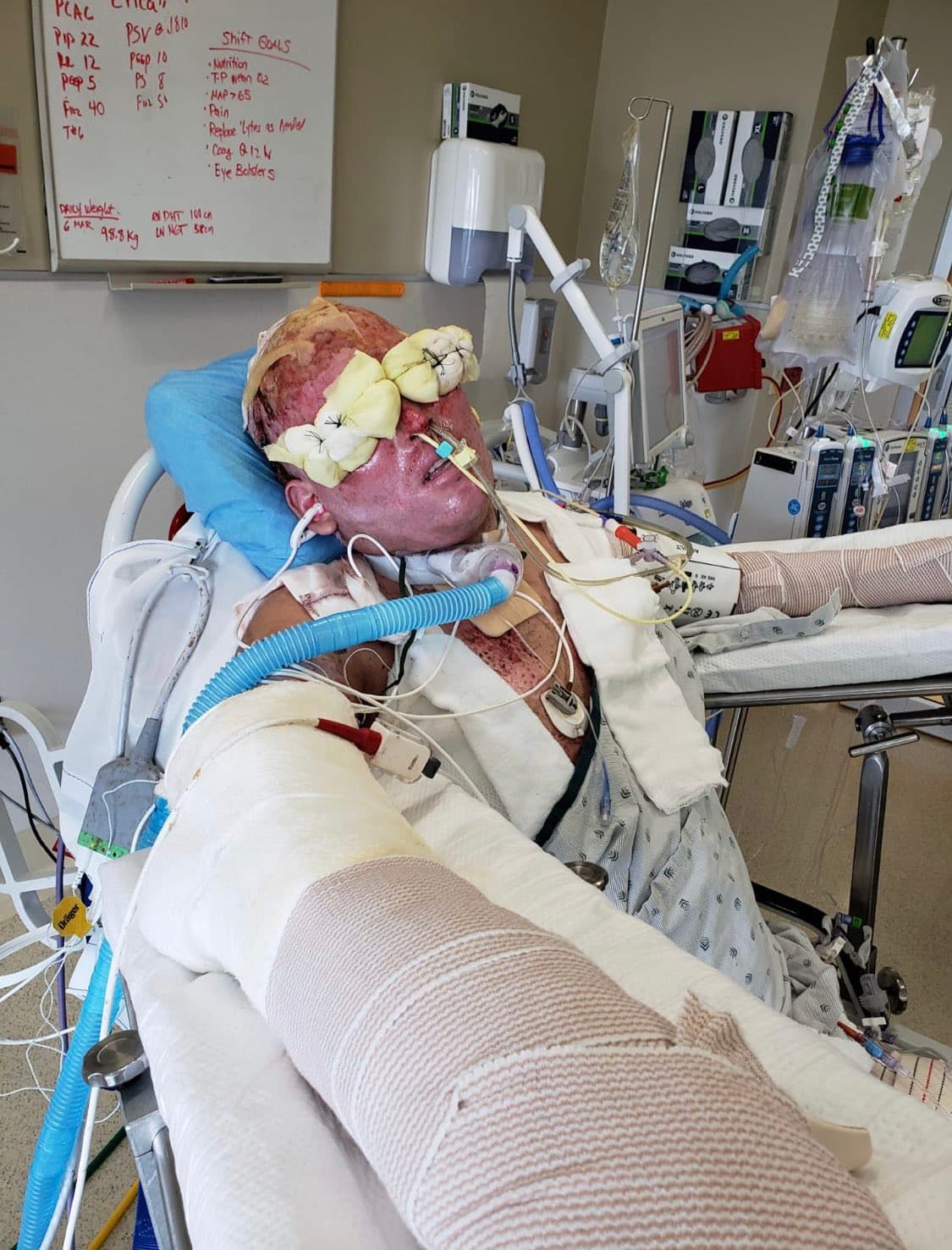 Tras varios días en terapia intensiva y con las pocas probabilidades de sobrevivir que le daban los médicos mexicanos, Hernández fue trasladado hasta el Brooke Army Medical Center de San Antonio, Texas, sitio en el que pasó 20 días en coma. 
<br>