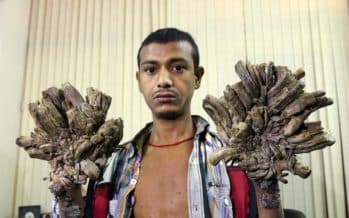 El mundo 
<a href="http://www.univision.com/noticias/enfermedad/la-odisea-del-hombre-arbol-que-por-fin-pudo-volver-a-ver-sus-manos">conoció a Abul Bajandar en 2016</a>, cuando sus manos y pies estaban cubiertos de verrugas causadas por una rara enfermedad relacionada con el virus del papiloma humano. 16 operaciones después, el hombre de Bangladesh pudo 'liberarse' y volver jugar con su hija.