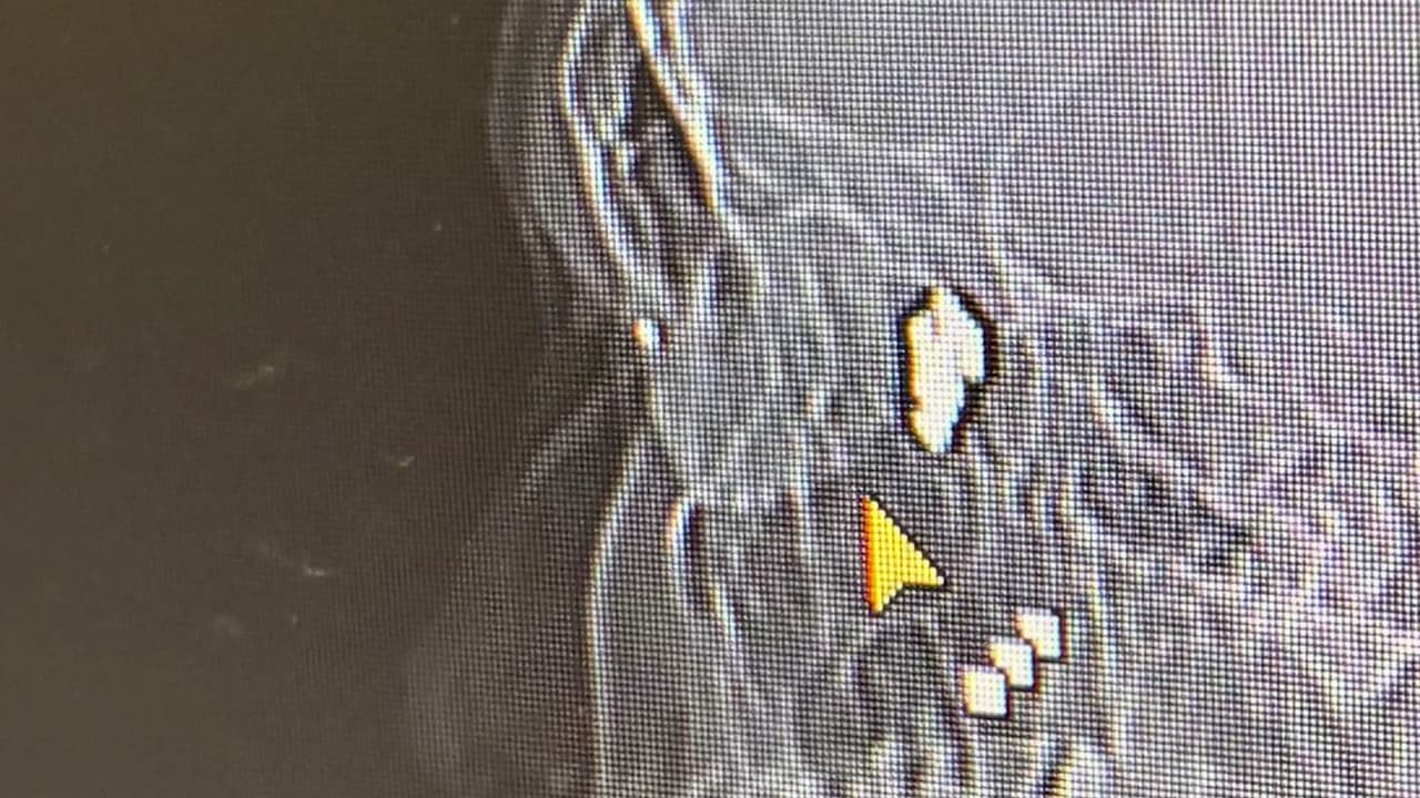 Joven latino sobrevive tras recibir fragmento de bala cerca de un ojo en California