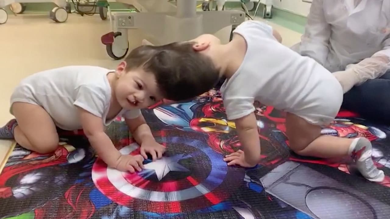 Ahora los niños, de 3 años, tendrán que estar en terapias durante unos seis meses. Según los médicos, es un caso que solo ocurre una vez cada 60,000 nacimientos.