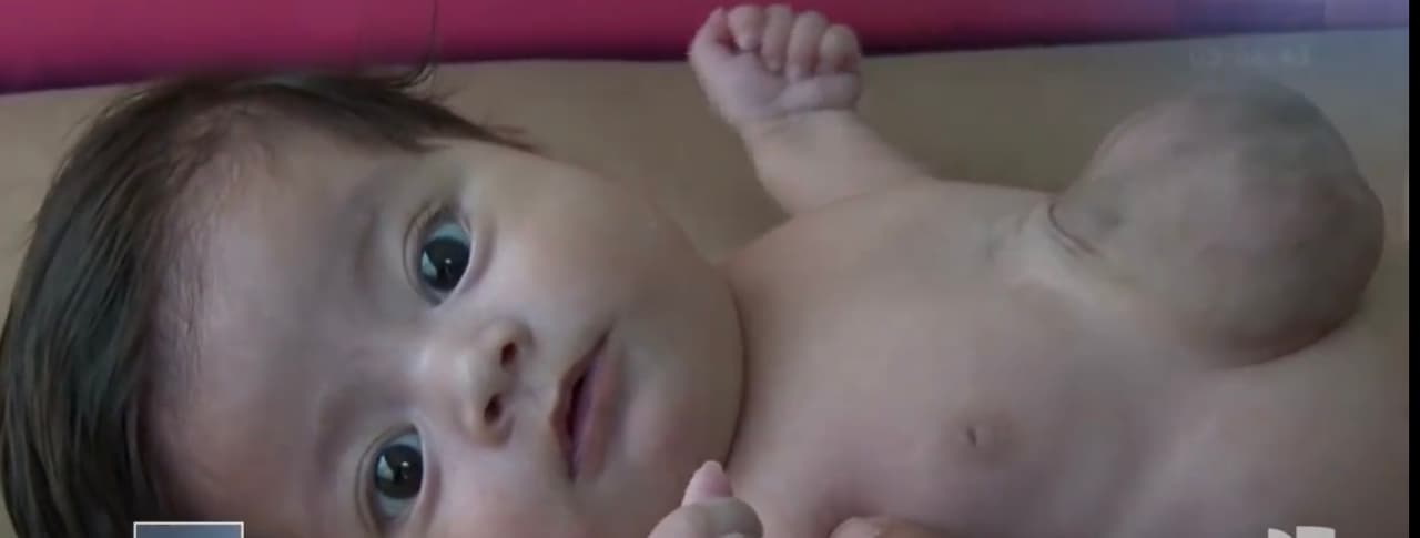 Sin embargo, mientras los doctores esperaban el
<a href="https://www.univision.com/temas/muertes">fatal desenlace</a> de la bebé, Marcela pronto comenzó a ganar peso y, aunque presentó diversas complicaciones como neumonía,
<b> superó con valentía los primeros días. </b>
<br>