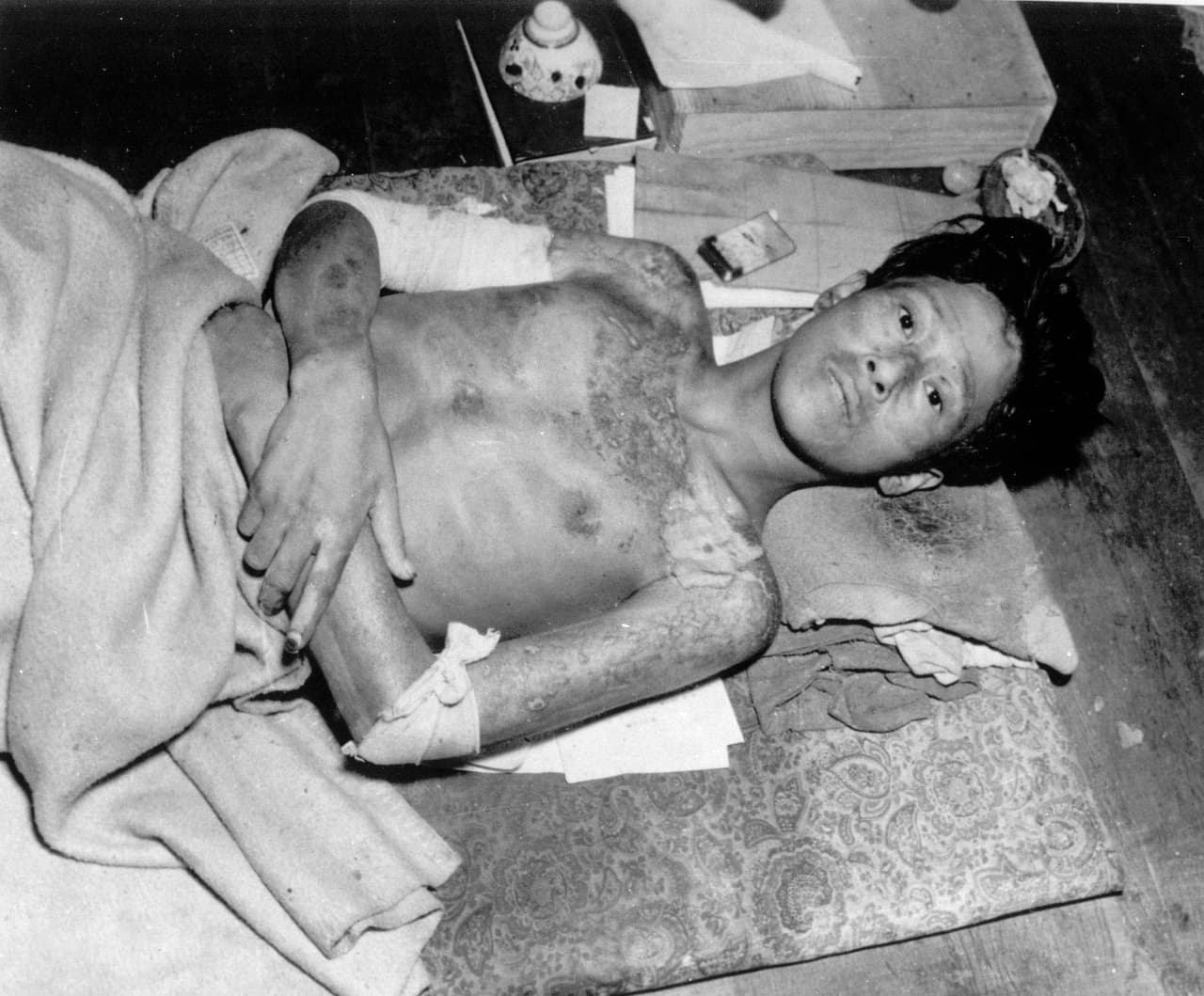 Un sobreviviente de la segunda explosión atómica sobre Japón, fotografía tomada a finales de 1945. Nagasaki fue importante por su actividad industrial para la producción de artillería, barcos y equipos bélicos durante la guerra.