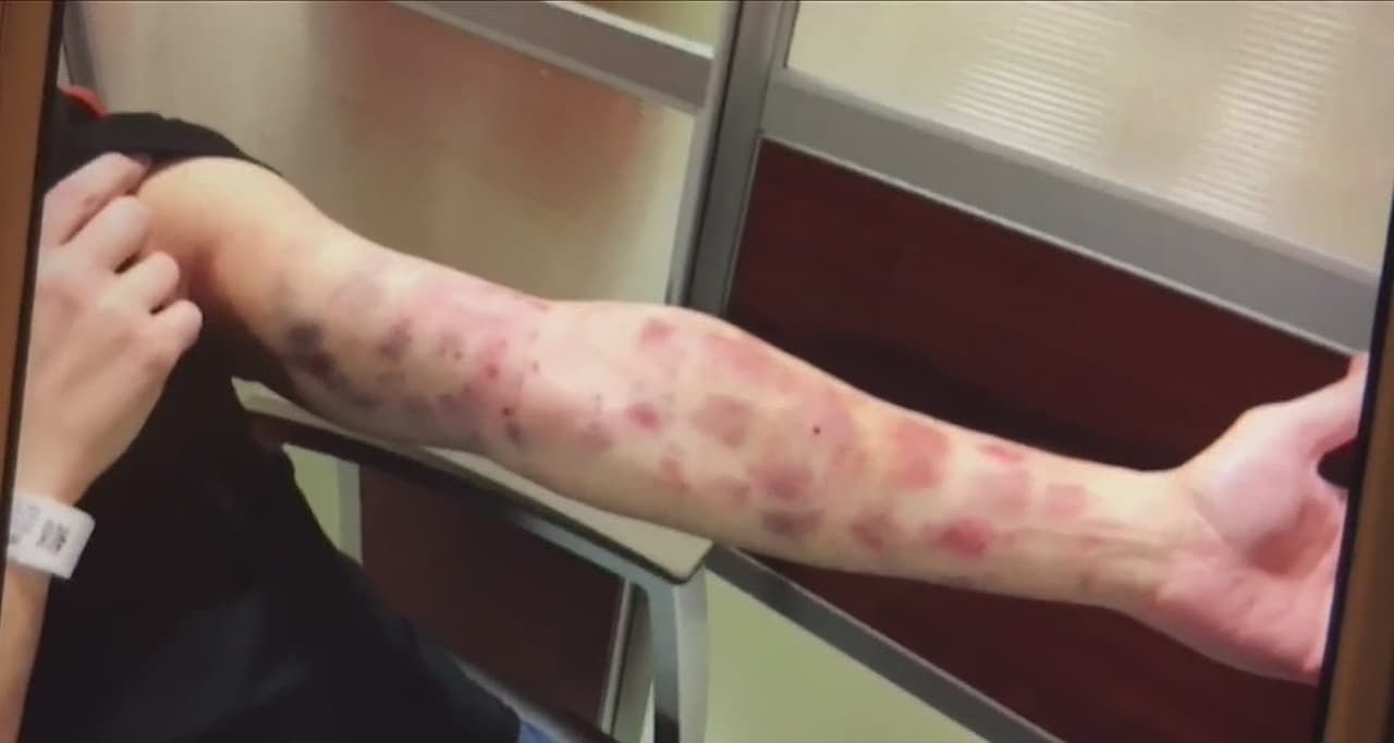 La mordedura de un insecto que envió a un hombre al hospital sigue siendo un misterio médico