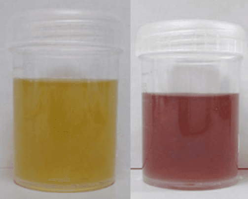 Hipersensibilidad a la luz, reacciones a alimentos como el ajo, palidez extrema y afán de comidas sangrientas: todos los ingredientes para crear uno de los mitos más sádicos, el vampiro. La enfermedad que provoca 
<a href="http://es.gizmodo.com/la-misteriosa-enfermedad-de-la-que-nace-el-mito-de-los-1704679992">todos estos síntomas es la porfiria</a>, una afección grave que en ocasiones deforma la fisionomía de quienes la padecen limando los dientes y afilando los huesos de la cara. La orina cambia a color púrpura tras la exposición al sol durante días seguidos.