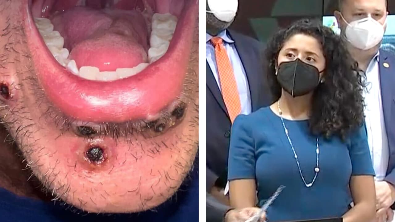 "¿Las vacunas? No hay suficientes": Lina Hidalgo explica cómo avanza la viruela del mono en el condado Harris