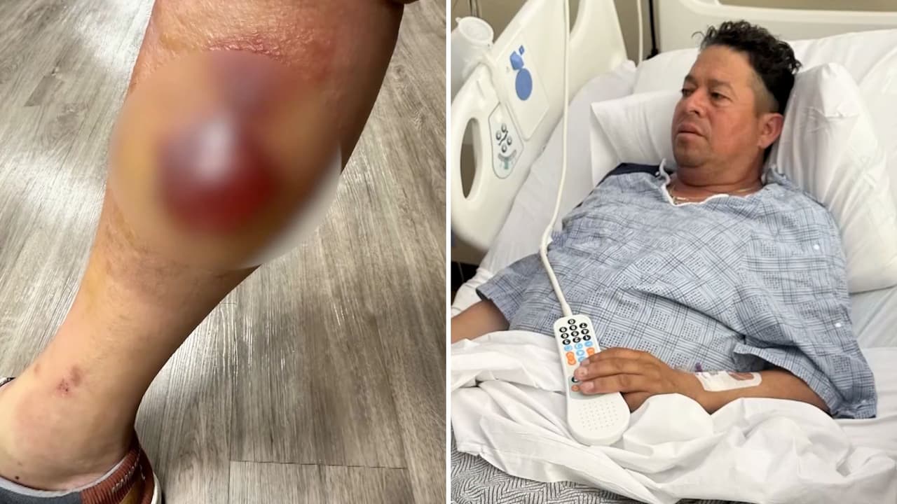 Una picadura en el patio terminó en dos cirugías y 20 días de hospital para un hispano en Texas