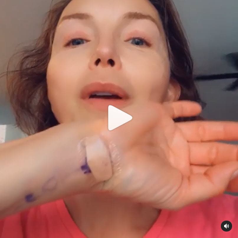 Un día después, el 16 de julio, explicó en un video
<b>por qué se sometió a la cirugía del túnel del carpo </b>y mostró cómo lucía una de sus muñecas.
<br>