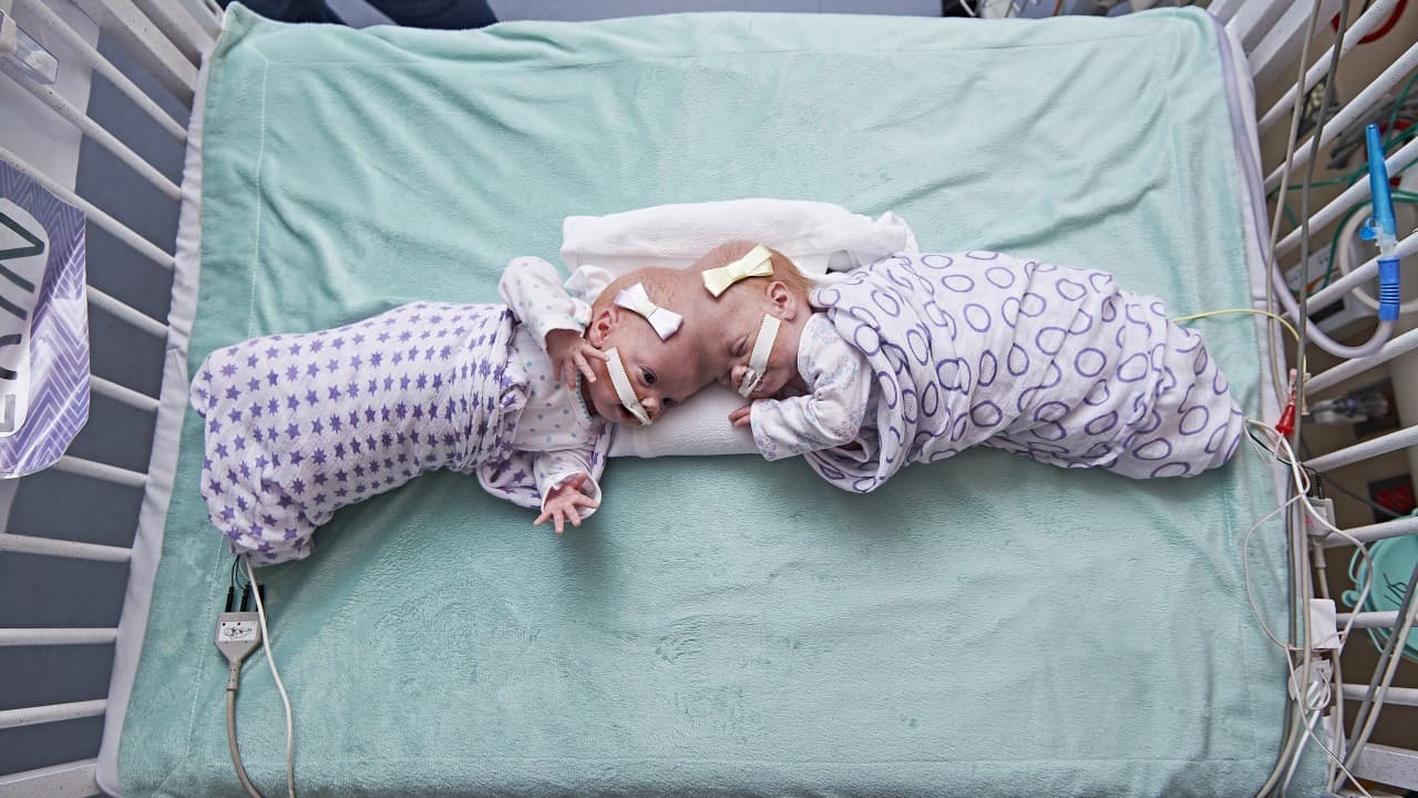 A sus 10 meses de vida, por primera vez las hermanas Erin y Abby pudieron dormir separadas.
<b>Las bebés de Carolina del Norte nacieron unidas por la cabeza y lograron sobrevivir </b>
<a href="http://www.univision.com/noticias/salud/las-siamesas-que-nacieron-unidas-por-la-cabeza-y-lograron-sobrevivir-al-ser-separadas">gracias a una delicada operación en el Children's Hospital de Filadelfia</a>. En el procedimiento médico participó un equipo de 30 especialistas. Esta condición afecta solo al 2% de los siameses.